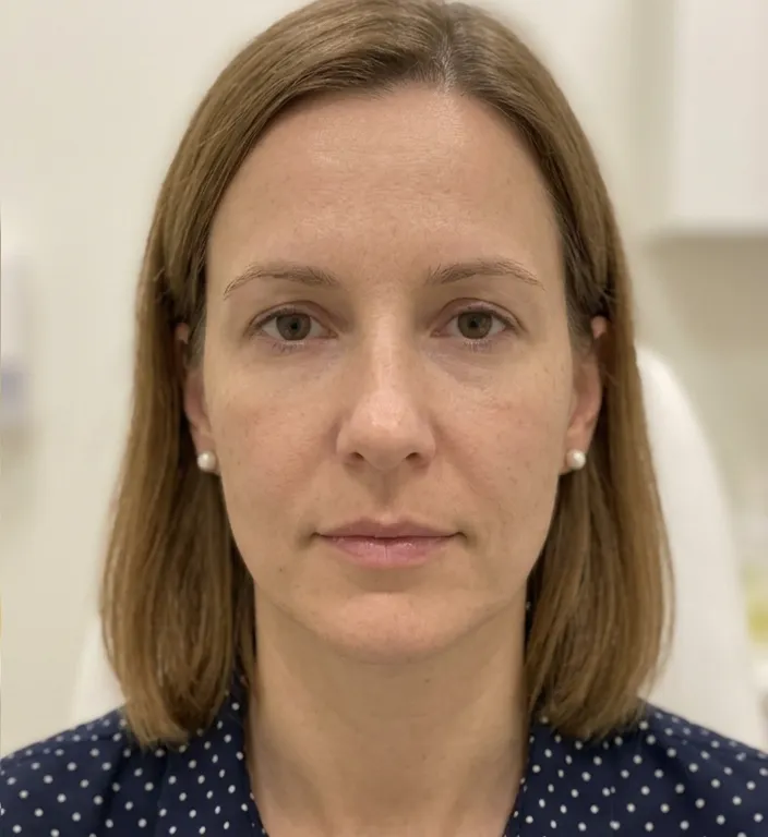 Nasolabialfalte nachher