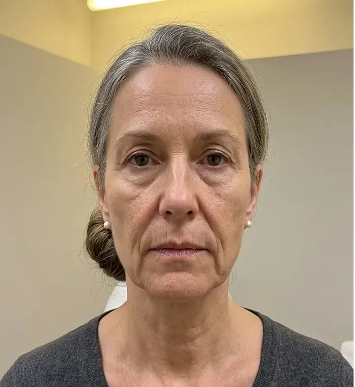 Nasolabialfalte vorher